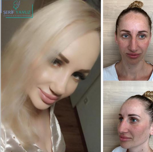 The result of our rhinoplasty patient from Ukraine.