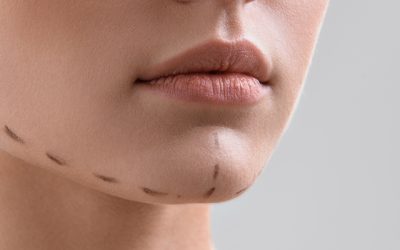 Çene Estetiği Ameliyatının (Çene Törpüleme) Herhangi Bir Riski Var mı?